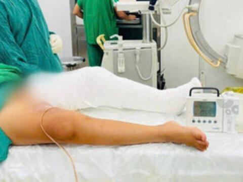 Phẫu thuật giải cứu cẳng chân bị co rút nặng do sẹo bỏng cho bé 9 tuổi